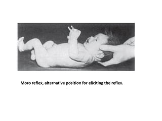 Moro reflex, alternative position for eliciting the reflex.
 