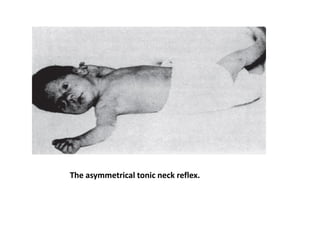 The asymmetrical tonic neck reflex.
 