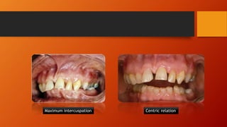 Introduction to occlusion | PPTX