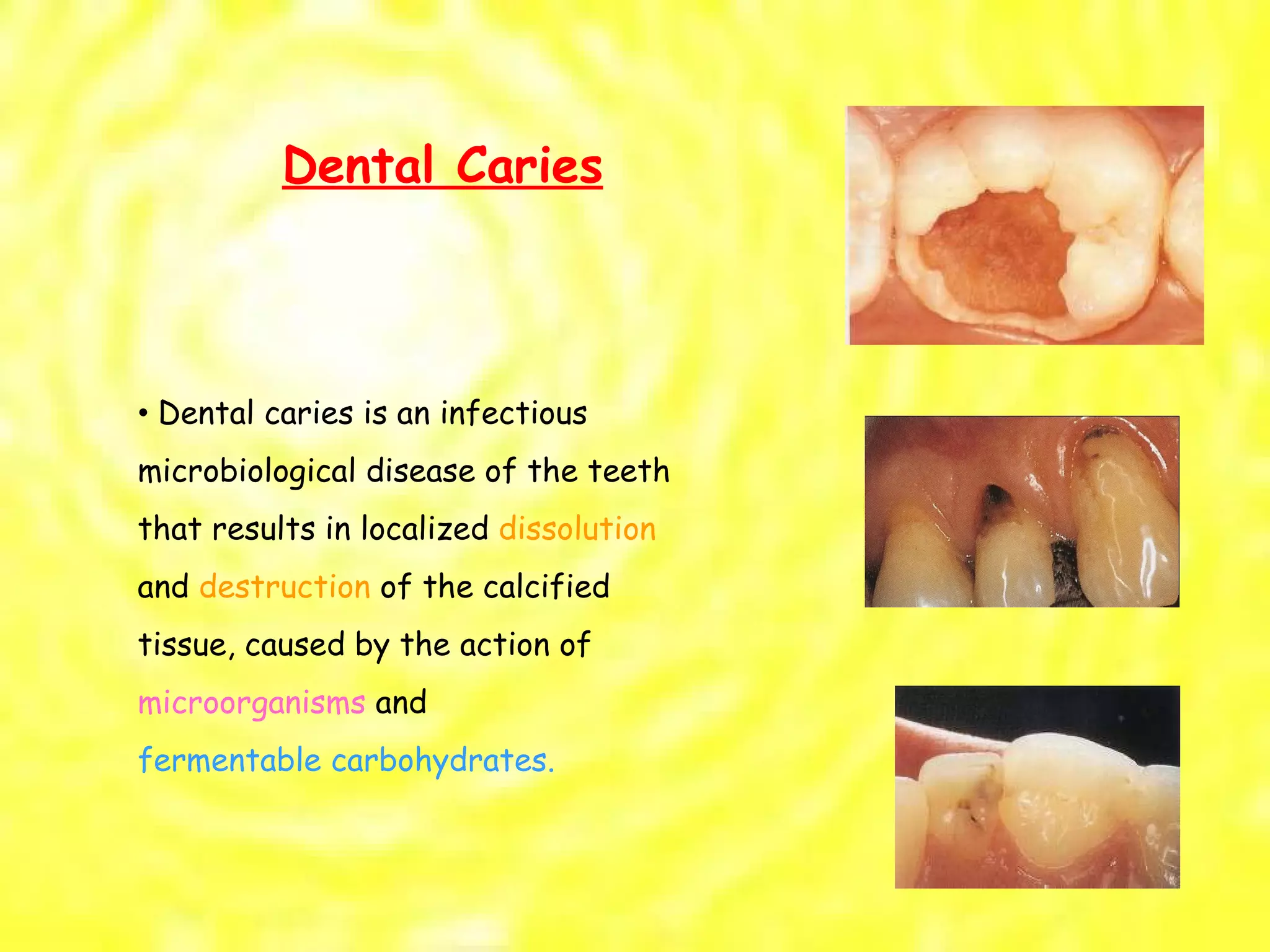 Dental Caries •  Dental caries is an infectious microbiological disease of the teeth that results in localized  dissolution and  destruction  of the calcified tissue, caused by the action of microorganisms  and fermentable carbohydrates. 