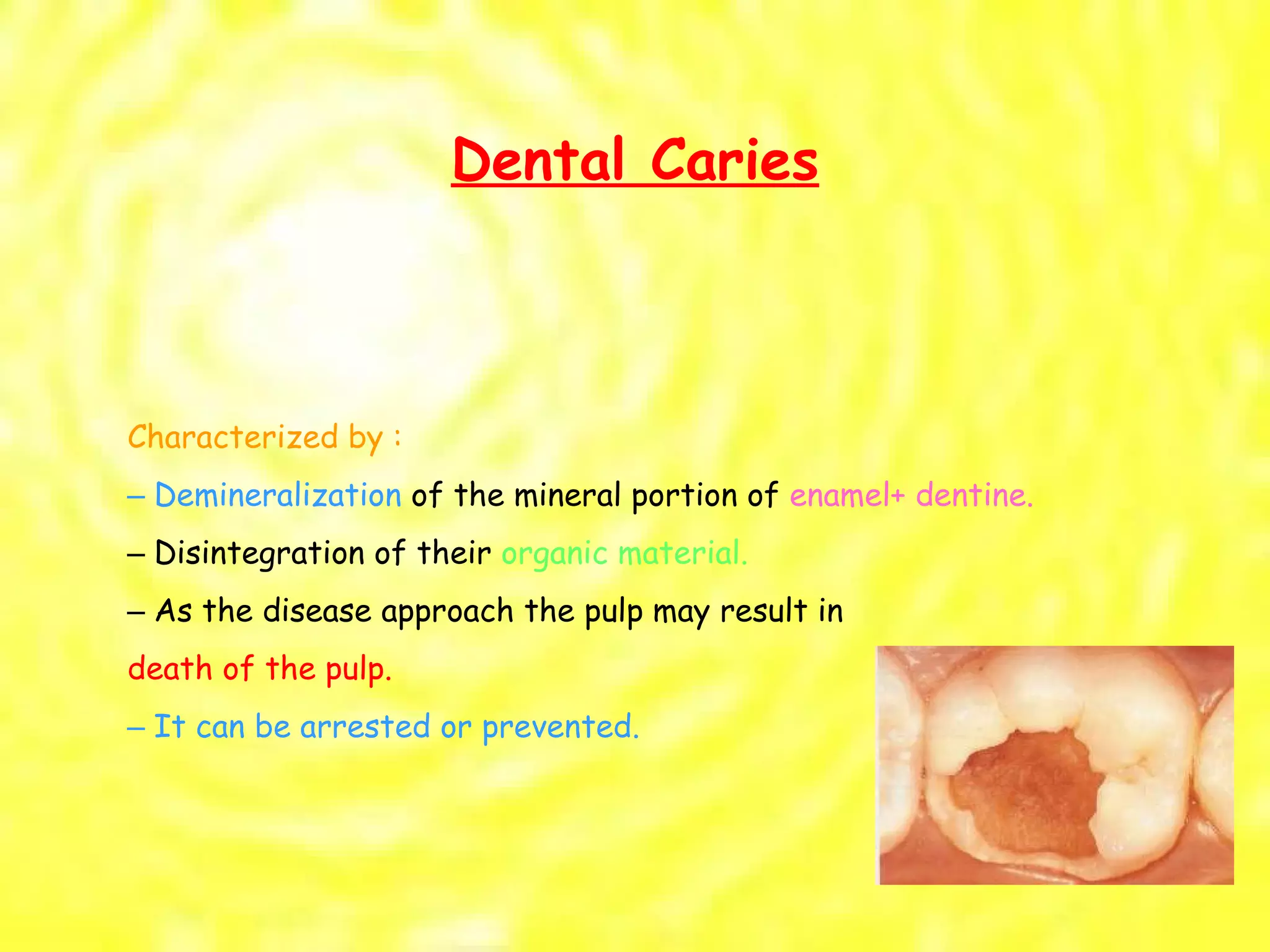 Dental Caries Characterized by : –  Demineralization  of the mineral portion of  enamel+ dentine. –  Disintegration of their  organic material. –  As the disease approach the pulp may result in death of the pulp. –  It can be arrested or prevented. 