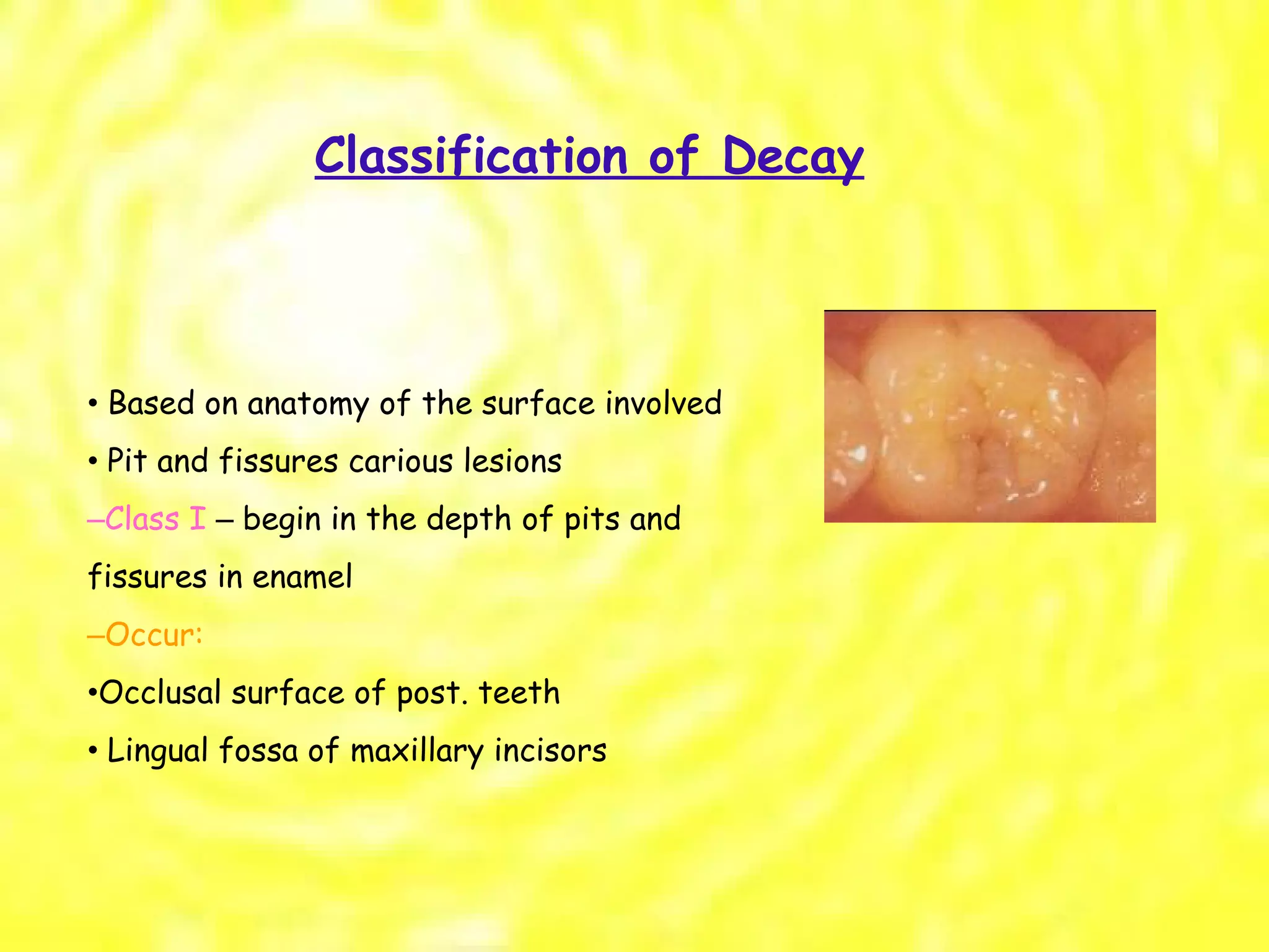 Classification of Decay •  Based on anatomy of the surface involved •  Pit and fissures carious lesions – Class I  –  begin in the depth of pits and fissures in enamel – Occur: • Occlusal surface of post. teeth •  Lingual fossa of maxillary incisors 