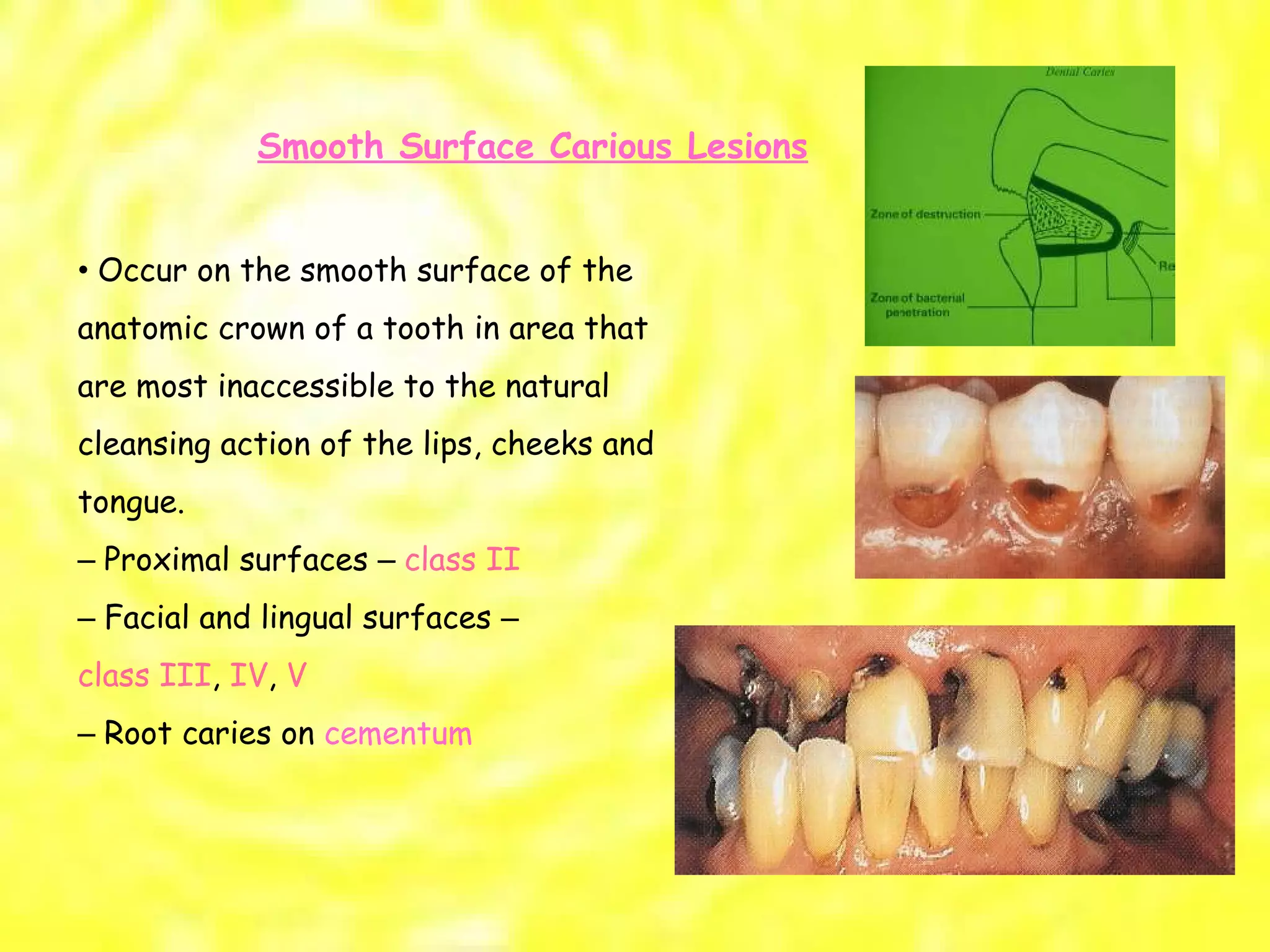Smooth Surface Carious Lesions •  Occur on the smooth surface of the anatomic crown of a tooth in area that are most inaccessible to the natural cleansing action of the lips, cheeks and tongue. –  Proximal surfaces  –  class II –  Facial and lingual surfaces  – class III ,  IV ,  V –  Root caries on  cementum 