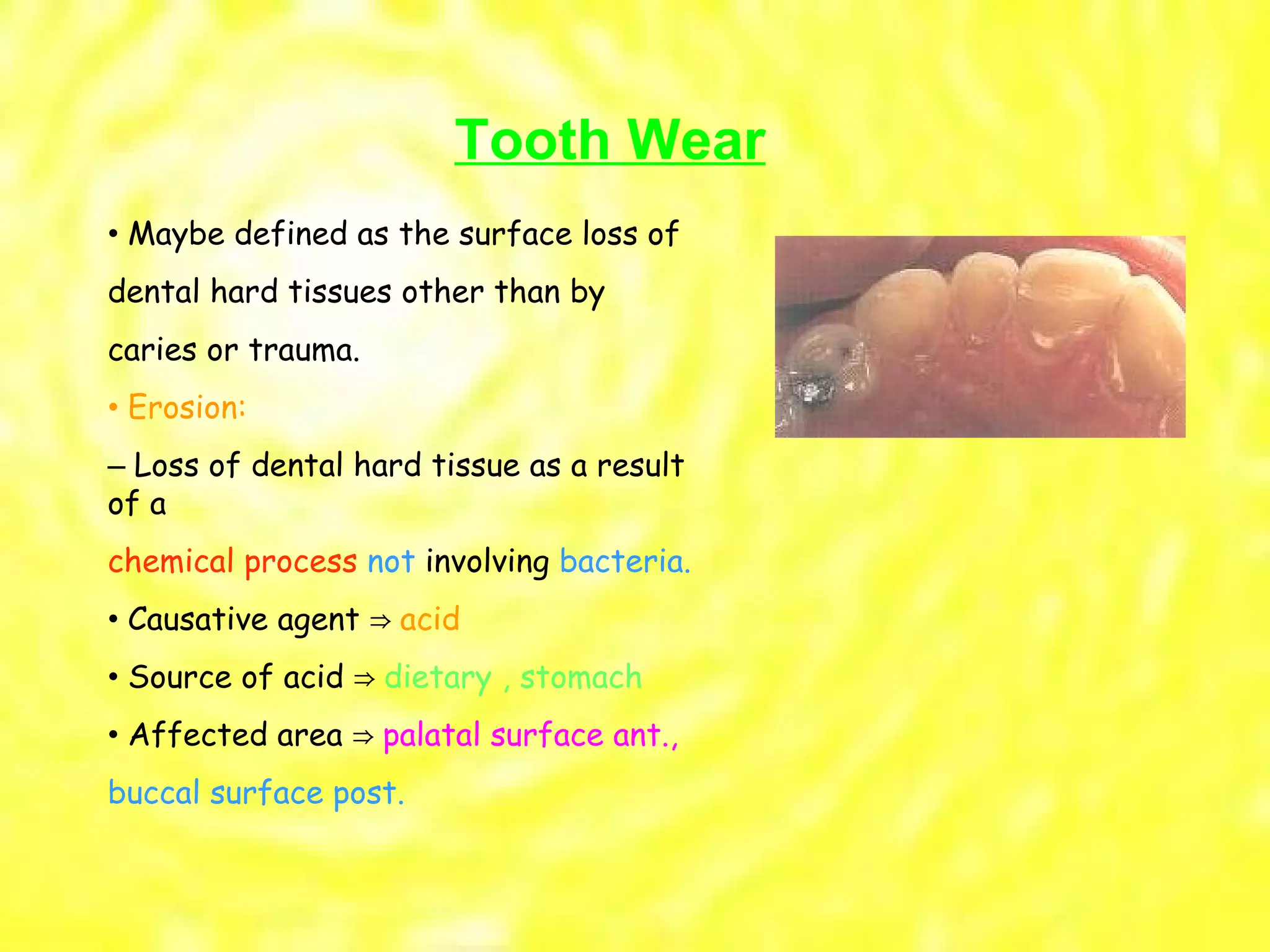 •  Maybe defined as the surface loss of dental hard tissues other than by caries or trauma. •  Erosion: –  Loss of dental hard tissue as a result of a chemical process  not  involving  bacteria. •  Causative agent  ⇒ acid •  Source of acid  ⇒ dietary , stomach •  Affected area  ⇒ palatal surface ant., buccal surface post. Tooth Wear 