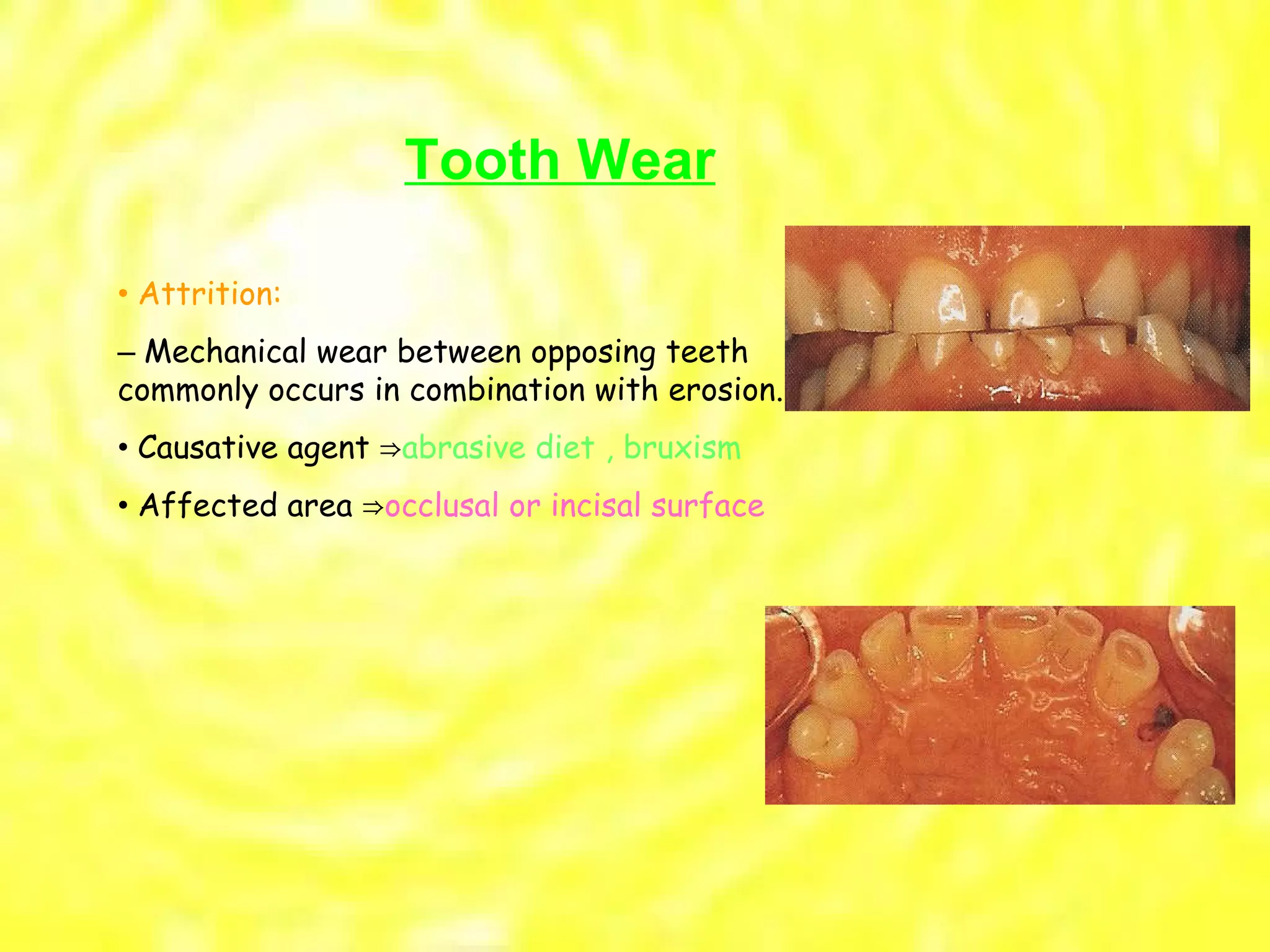 •  Attrition: –  Mechanical wear between opposing teeth commonly occurs in combination with erosion. •  Causative agent  ⇒ abrasive diet , bruxism •  Affected area  ⇒ occlusal or incisal surface Tooth Wear 