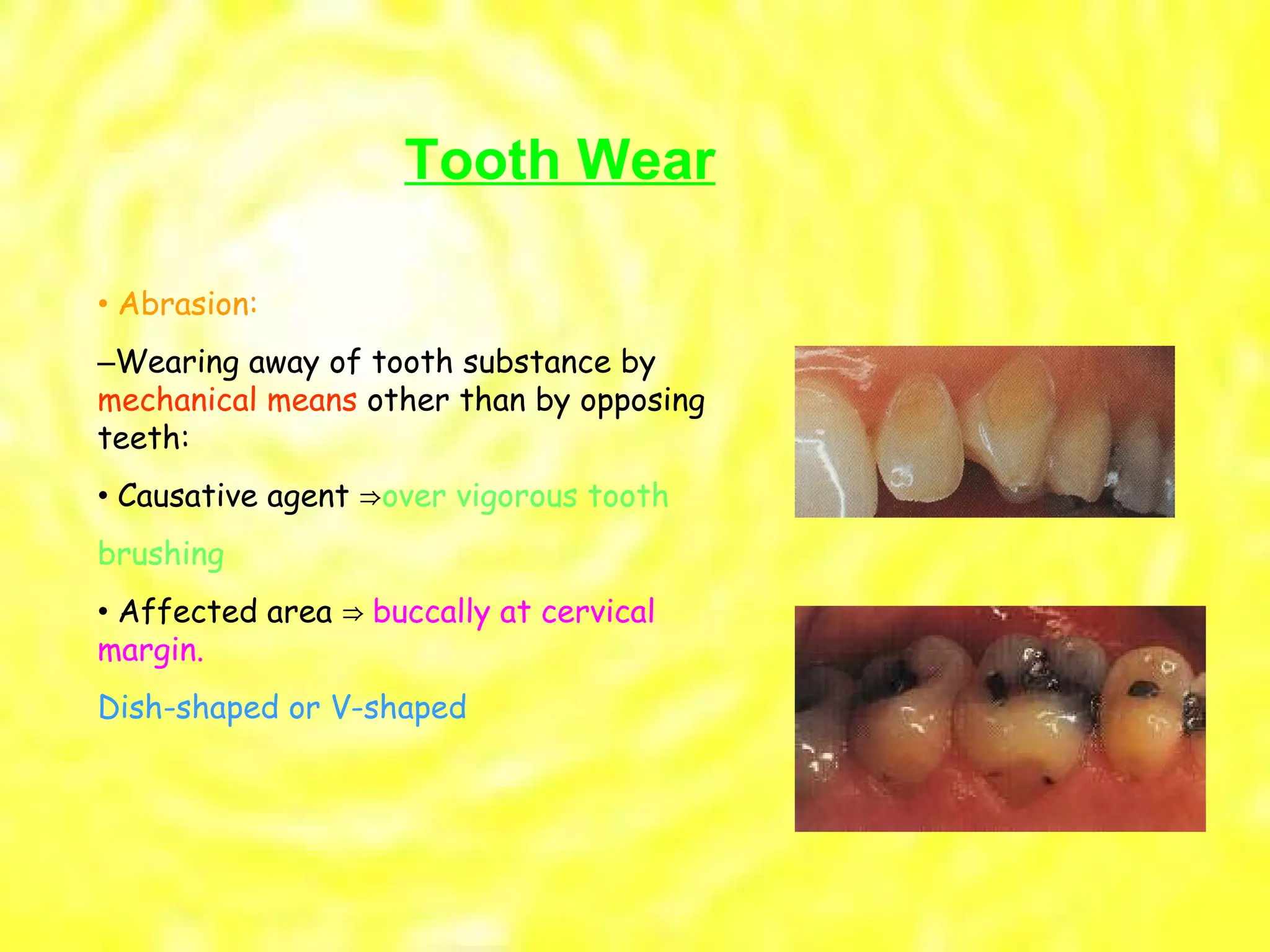 •  Abrasion: – Wearing away of tooth substance by  mechanical means  other than by opposing teeth: •  Causative agent  ⇒ over vigorous tooth brushing •  Affected area  ⇒ buccally at cervical margin. Dish-shaped or V-shaped Tooth Wear 