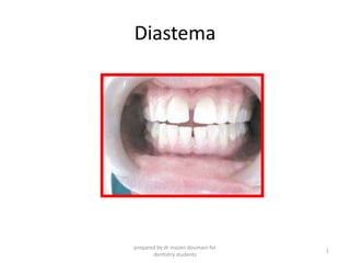Diastema
prepared by dr mazen doumani for
dentistry students
1
 