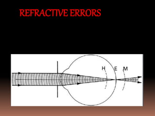 Reflective Error Introduction to ophthalmolgy for medical students | PPTX