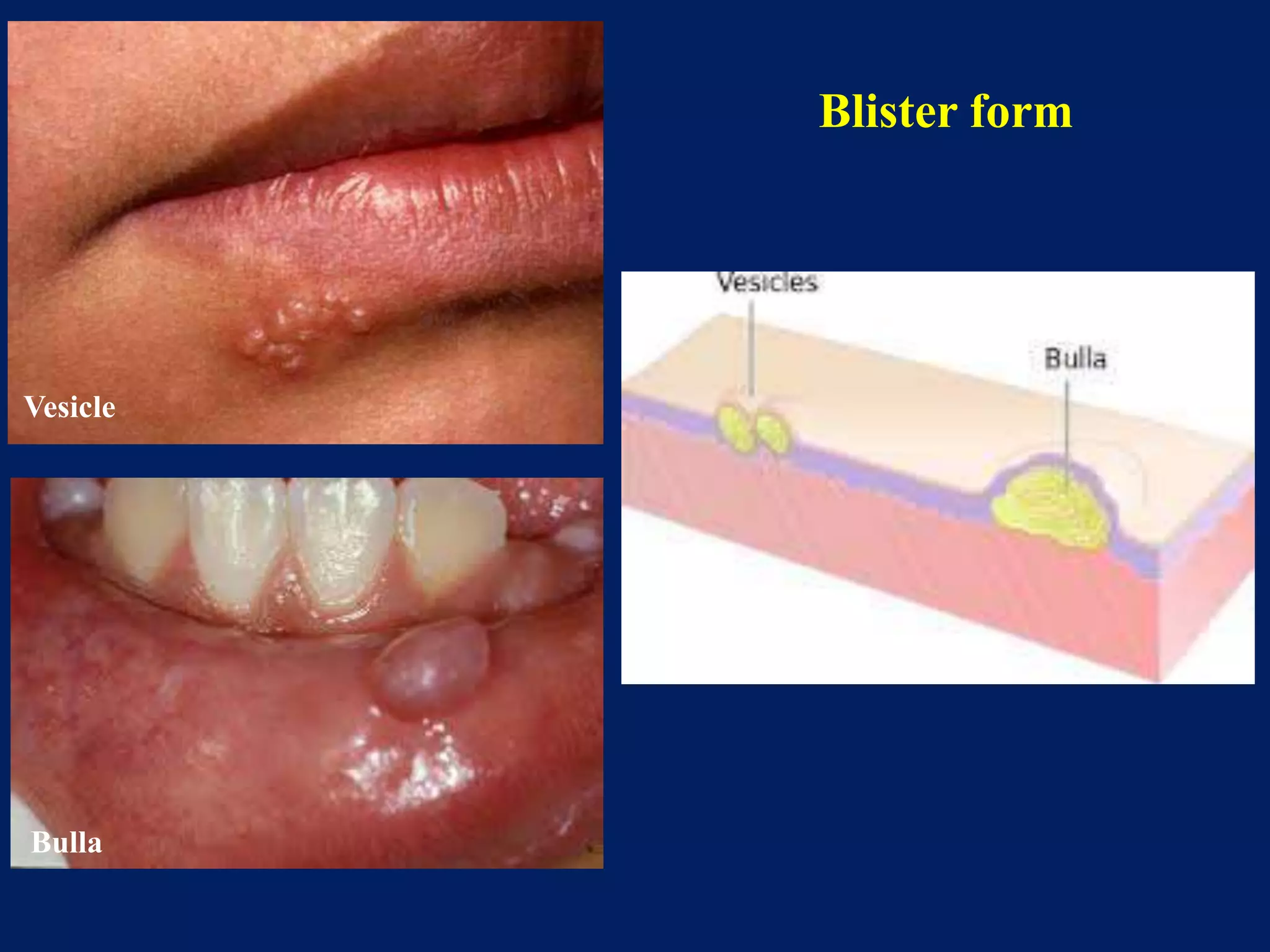 Blister form
Vesicle
Bulla
 