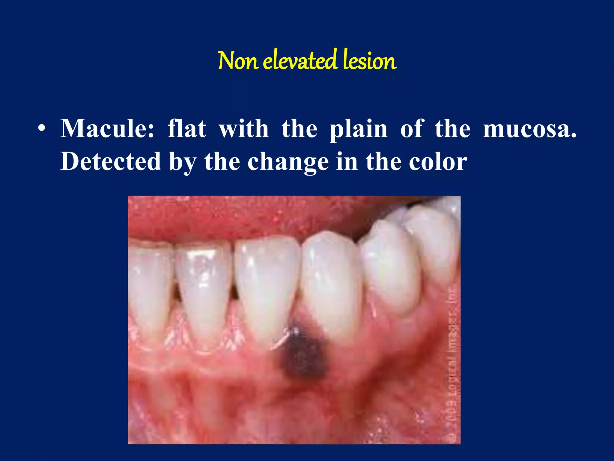 Non elevated lesion
• Macule: flat with the plain of the mucosa.
Detected by the change in the color
 