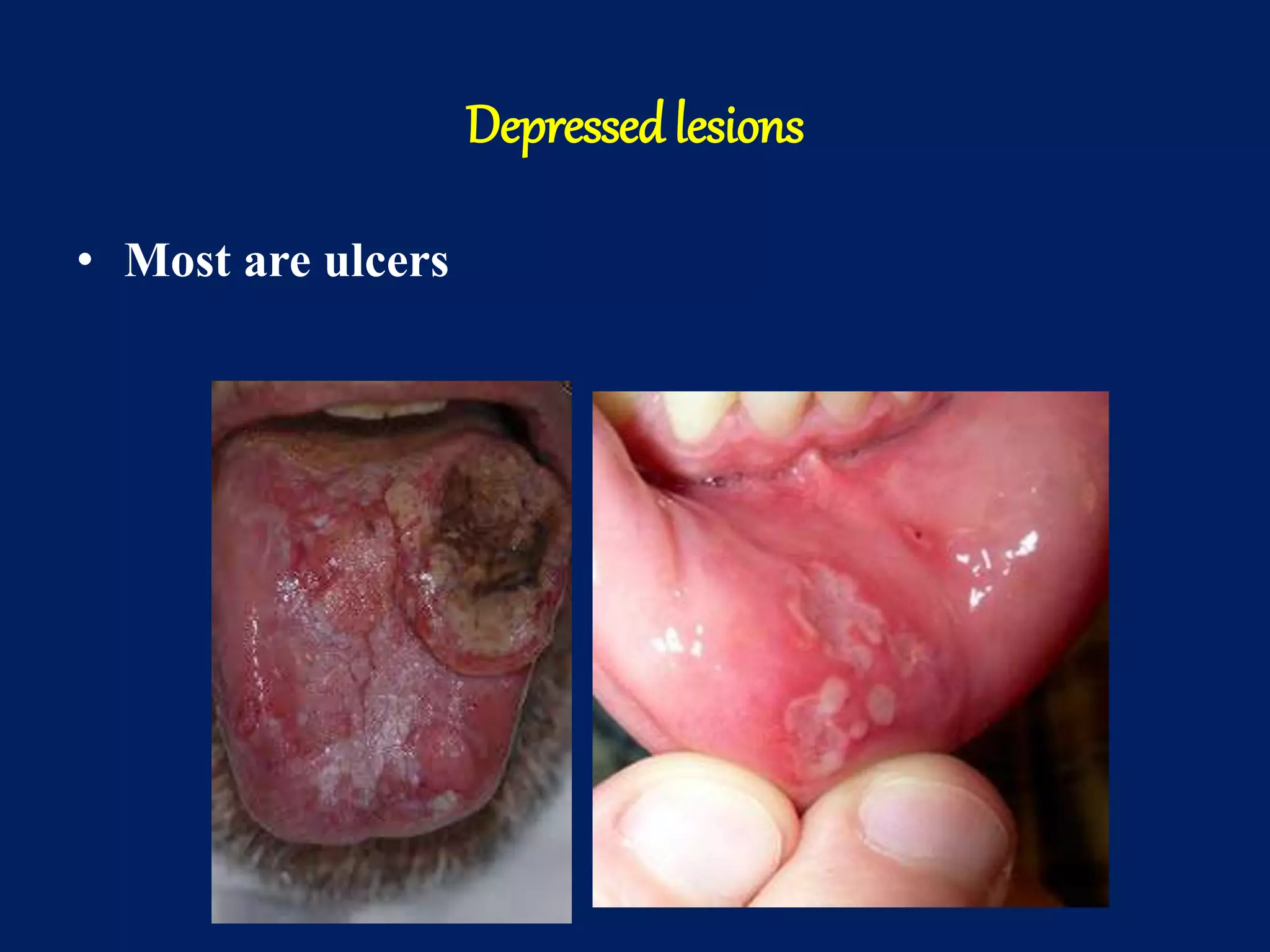 Depressedlesions
• Most are ulcers
 