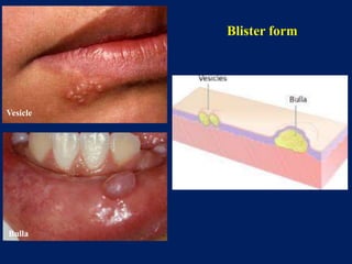 Bulla Photo Introduction to oral pathology | PPTX