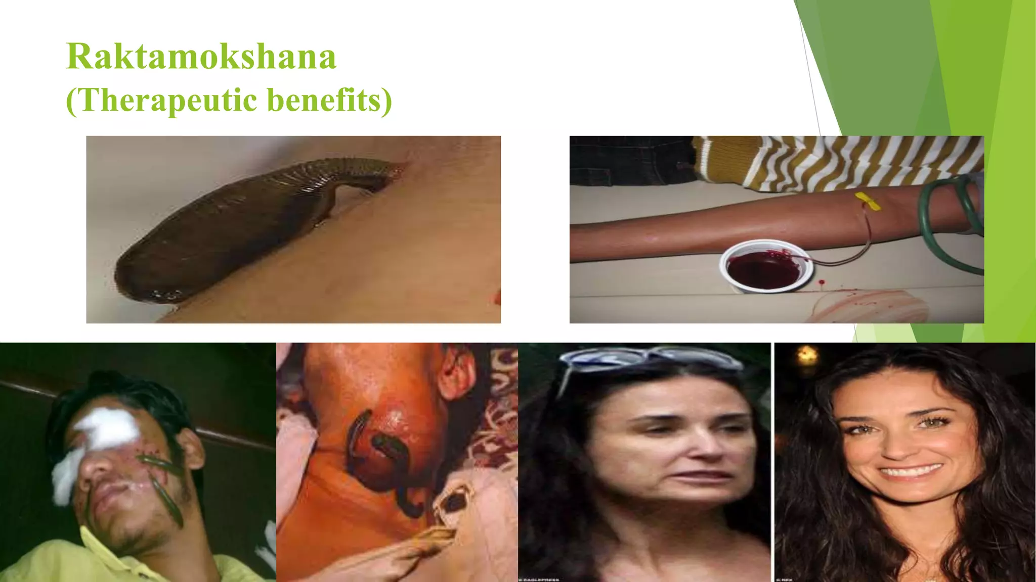 Raktamokshana
(Therapeutic benefits)
 