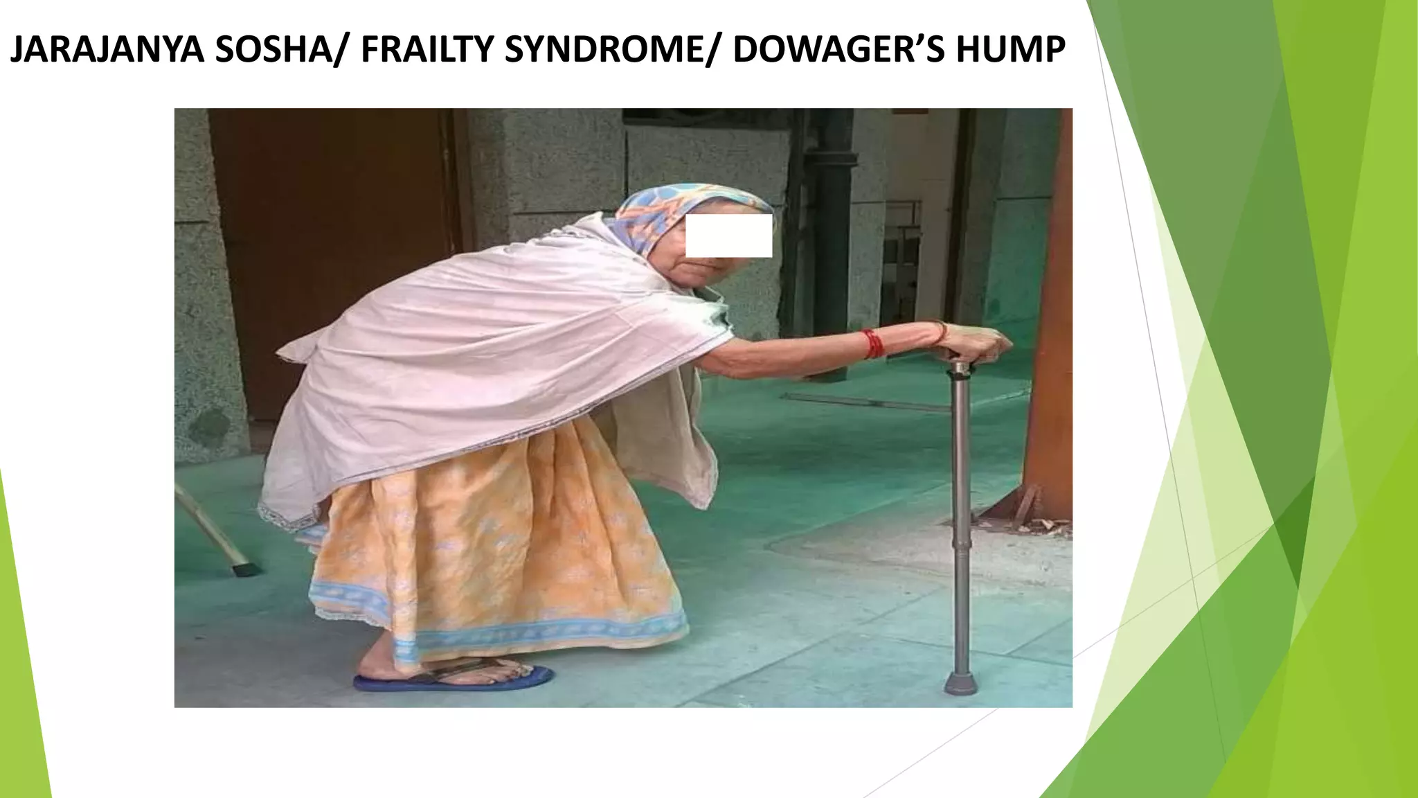 JARAJANYA SOSHA/ FRAILTY SYNDROME/ DOWAGER&rsquo;S HUMP
 