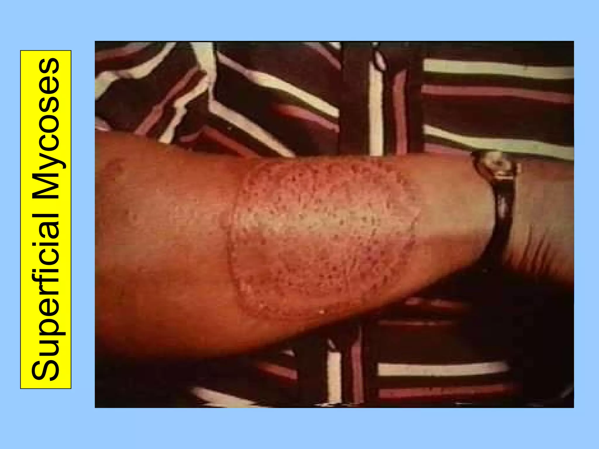 Superficial Mycoses 