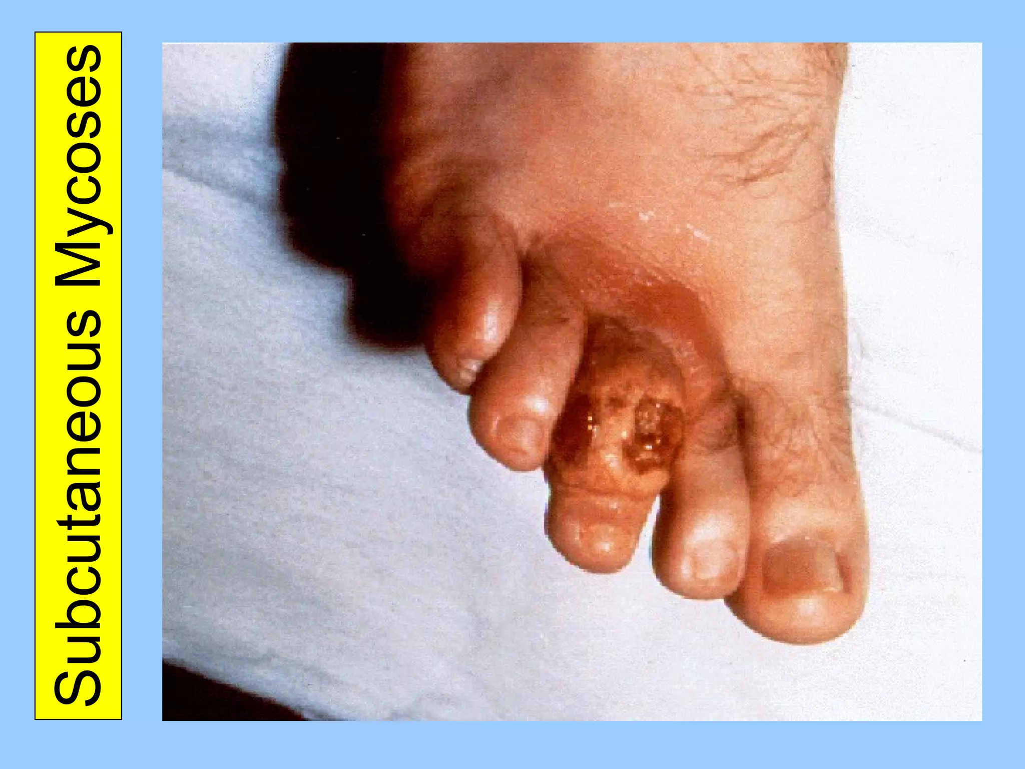 Subcutaneous Mycoses 