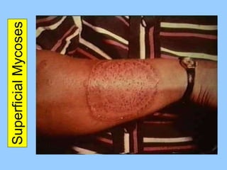Superficial Mycoses 