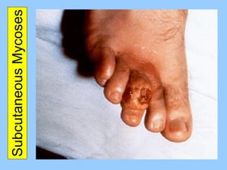 Subcutaneous Mycoses 