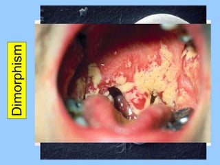 Dimorphism Some fungi can grow as yeasts or as hyphae, depending on growth conditions This can lead to a single fungal species being classified as more than one species Fungi also can display sexual versus asexual growth, further confusing fungal classification 