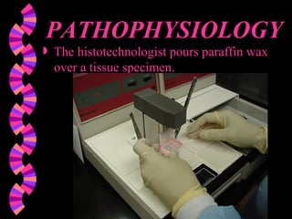 PATHOPHYSIOLOGY The histotechnologist pours paraffin wax over a tissue specimen. 