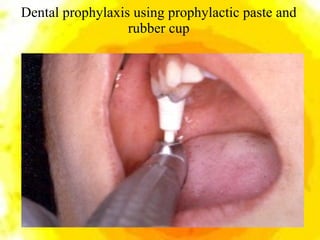 Dental prophylaxis using prophylactic paste and rubber cup 