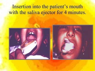 Insertion into the patient’s mouth with the saliva ejector for 4 minutes. 