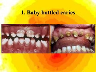1. Baby bottled caries 