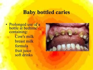 Baby bottled caries <ul><li>Prolonged use of a bottle at bedtime containing: </li></ul><ul><li>Cow's milk </li></ul><ul><l...