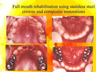 Full mouth rehabilitation using stainless steel crowns and composite restorations 