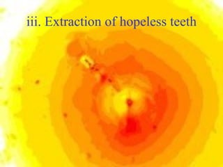 iii. Extraction of hopeless teeth 