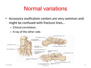 Normal variations
• Accessory ossification centers are very common and
might be confused with fracture lines…
– Clinical correlation.
– X-ray of the other side.
7/22/2020
Thamer Alhussainan, M.D.
KFSH & RC
12
 
