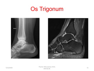 Os Trigonum
7/22/2020
Thamer Alhussainan, M.D.
KFSH & RC
15
 
