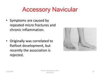 Accessory Navicular
• Symptoms are caused by
repeated micro fractures and
chronic inflammation.
• Originally was correlated to
flatfoot development, but
recently the association is
rejected.
7/22/2020
Thamer Alhussainan, M.D.
KFSH & RC
18
 