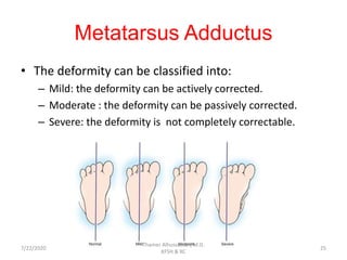 Metatarsus Adductus
• The deformity can be classified into:
– Mild: the deformity can be actively corrected.
– Moderate : the deformity can be passively corrected.
– Severe: the deformity is not completely correctable.
7/22/2020
Thamer Alhussainan, M.D.
KFSH & RC
25
 