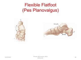 Flexible Flatfoot
(Pes Planovalgus)
7/22/2020
Thamer Alhussainan, M.D.
KFSH & RC
39
 