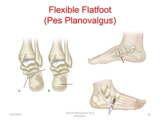 Flexible Flatfoot
(Pes Planovalgus)
7/22/2020
Thamer Alhussainan, M.D.
KFSH & RC
40
 