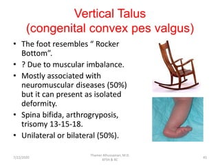 Vertical Talus
(congenital convex pes valgus)
• The foot resembles “ Rocker
Bottom”.
• ? Due to muscular imbalance.
• Mostly associated with
neuromuscular diseases (50%)
but it can present as isolated
deformity.
• Spina bifida, arthrogryposis,
trisomy 13-15-18.
• Unilateral or bilateral (50%).
7/22/2020
Thamer Alhussainan, M.D.
KFSH & RC
45
 