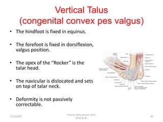 Vertical Talus
(congenital convex pes valgus)
• The hindfoot is fixed in equinus.
• The forefoot is fixed in dorsiflexion,
valgus position.
• The apex of the “Rocker” is the
talar head.
• The navicular is dislocated and sets
on top of talar neck.
• Deformity is not passively
correctable.
7/22/2020
Thamer Alhussainan, M.D.
KFSH & RC
46
 