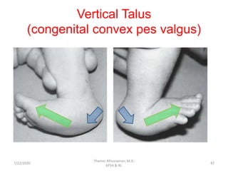 Vertical Talus
(congenital convex pes valgus)
7/22/2020
Thamer Alhussainan, M.D.
KFSH & RC
47
 
