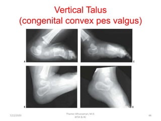 Vertical Talus
(congenital convex pes valgus)
7/22/2020
Thamer Alhussainan, M.D.
KFSH & RC
48
 