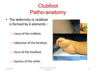 Clubfoot
Patho-anatomy
• The deformity in clubfoot
is formed by 4 elements :
– Cavus of the midfoot.
– Adduction of the forefoot.
– Varus of the hindfoot.
– Equinus of the ankle.
7/22/2020
Thamer Alhussainan, M.D.
KFSH & RC
53
 