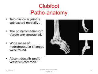Clubfoot
Patho-anatomy
• Talo-navicular joint is
subluxated medially .
• The posteromedial soft
tissues are contracted.
• Wide range of
neuromuscular changes
were found.
• Absent dorsalis pedis
vessels is common.
7/22/2020
Thamer Alhussainan, M.D.
KFSH & RC
54
 