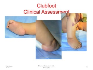 Clubfoot
Clinical Assessment
7/22/2020
Thamer Alhussainan, M.D.
KFSH & RC
57
 