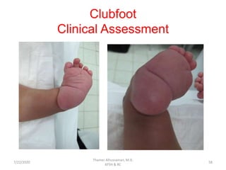Clubfoot
Clinical Assessment
7/22/2020
Thamer Alhussainan, M.D.
KFSH & RC
58
 
