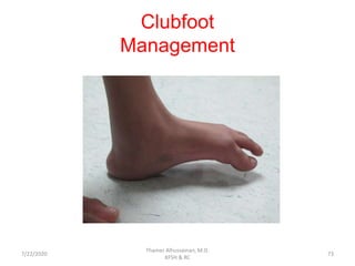 Clubfoot
Management
7/22/2020
Thamer Alhussainan, M.D.
KFSH & RC
73
 