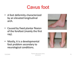 Cavus foot
• A foot deformity characterized
by an elevated longitudinal
arch.
• Caused by fixed plantar flexion
of the forefoot (mainly the first
ray).
• Mostly, it is a developmental
foot problem secondary to
neurological conditions.
7/22/2020
Thamer Alhussainan, M.D.
KFSH & RC
75
 
