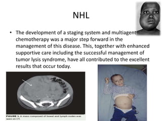 NHL
• The development of a staging system and multiagent
chemotherapy was a major step forward in the
management of this disease. This, together with enhanced
supportive care including the successful management of
tumor lysis syndrome, have all contributed to the excellent
results that occur today.
 