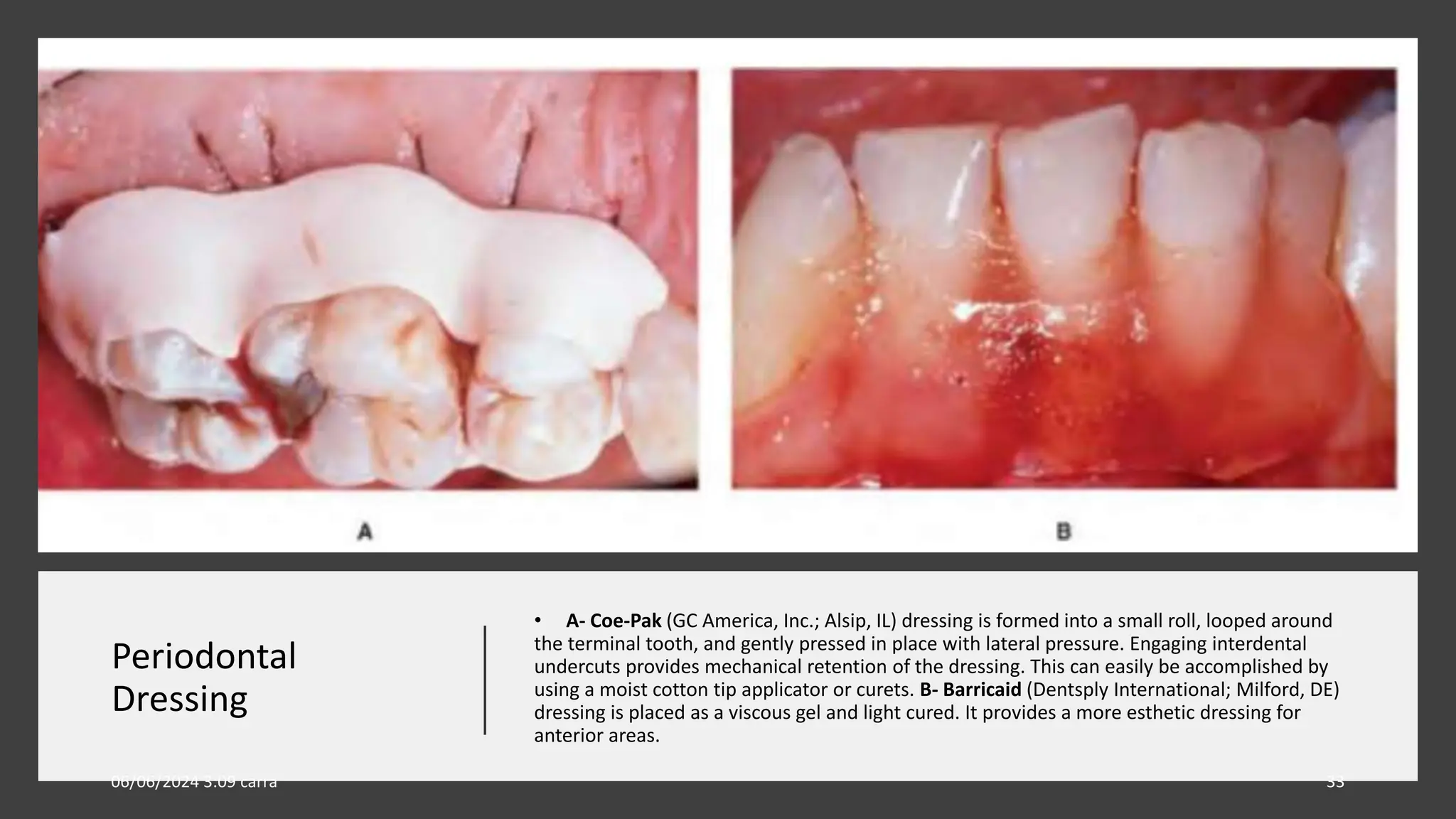 Periodontal
Dressing
• A- Coe-Pak (GC America, Inc.; Alsip, IL) dressing is formed into a small roll, looped around
the terminal tooth, and gently pressed in place with lateral pressure. Engaging interdental
undercuts provides mechanical retention of the dressing. This can easily be accomplished by
using a moist cotton tip applicator or curets. B- Barricaid (Dentsply International; Milford, DE)
dressing is placed as a viscous gel and light cured. It provides a more esthetic dressing for
anterior areas.
06/06/2024 3:09 carra 33
 