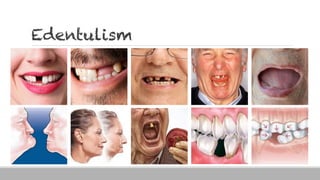 Edentulism
 