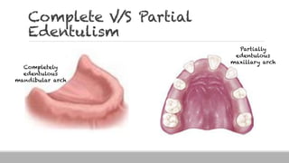 Complete V/S Partial
Edentulism
Completely
edentulous
mandibular arch
Partially
edentulous
maxillary arch
 